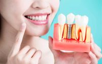 Migliore Implantologia Dentale Milano